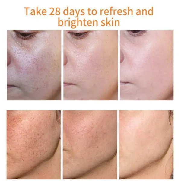 Whitening Freckles Cream Remove Melasma Dark Spot Lightening Melanin Brightening Melasma Remover Moisturize Anti-aging Face Care - Image 4
