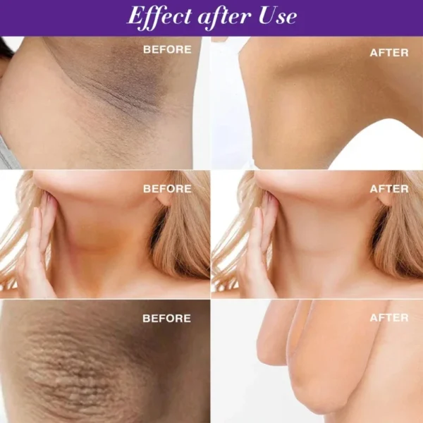 Whitening Cream Private Parts Underarm Bleaching Whiten Butt Knee Brighten Inner Thigh Intimate Parts Dark Remove Melanin Care - Image 2