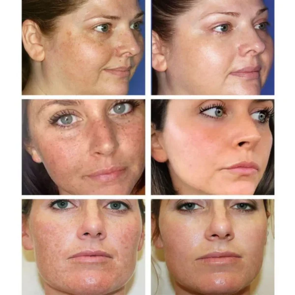 Whitening Freckles Cream Remove Melasma Dark Spot Lightening Melanin Brightening Melasma Remover Moisturize Anti-aging Face Care - Image 5